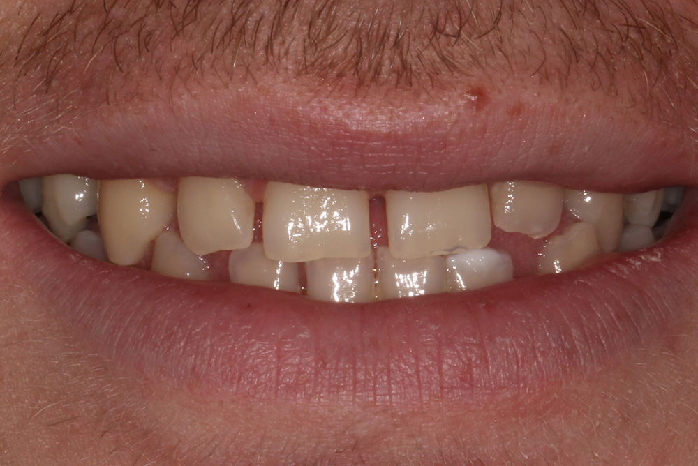 Composite Bonding Northern Ireland Dentistry Markethill