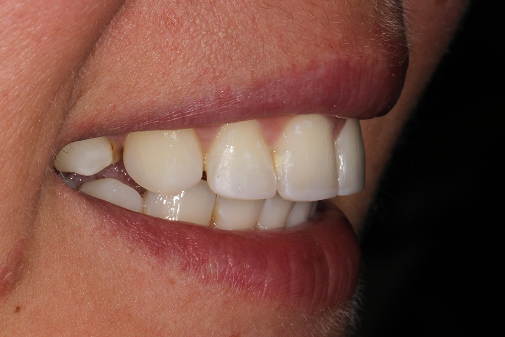 Adult Braces in County Armagh Dentistry Markethill