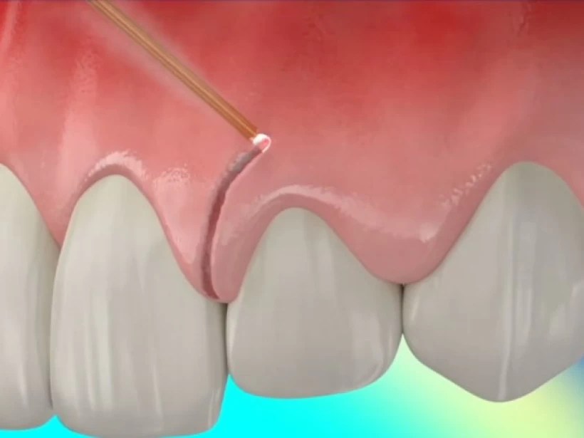 Learn about gum contouring before and after, and what happens during