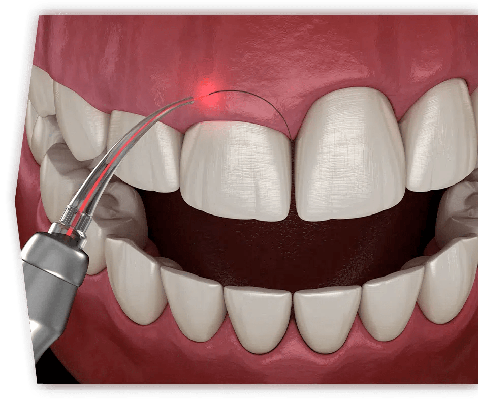 Dentist South Austin TX Craft of Dentistry Gingivectomy