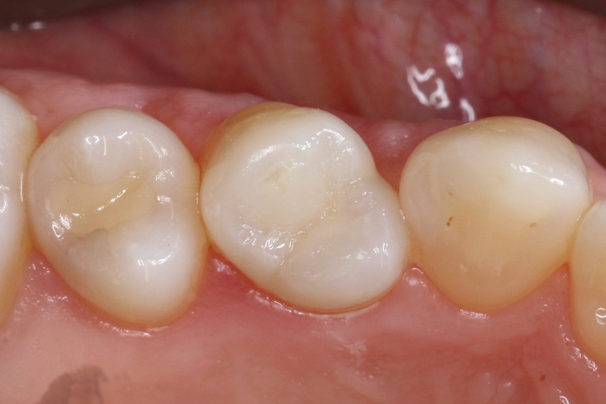 White Fillings Frequently Asked Questions Composite Fillings Before After