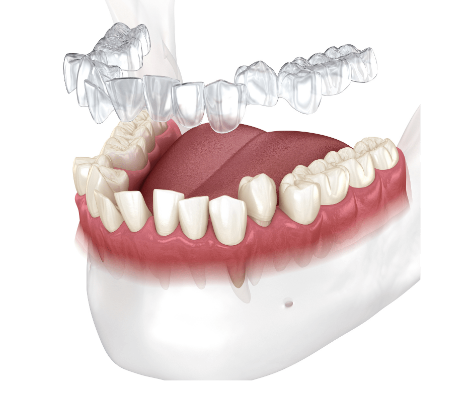 Invisalign Magnolia Modern Dentistry Dentist in Yuba City, CA