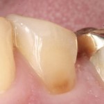 Tooth wear cervical lesion