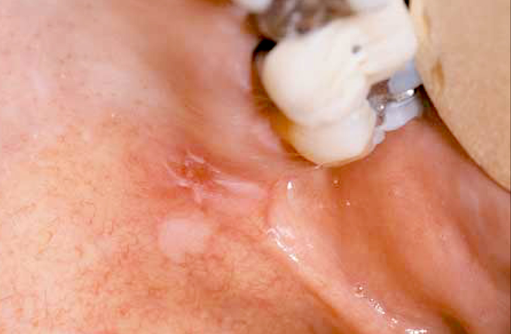 Leukoplakia lesion with severe dysplasia