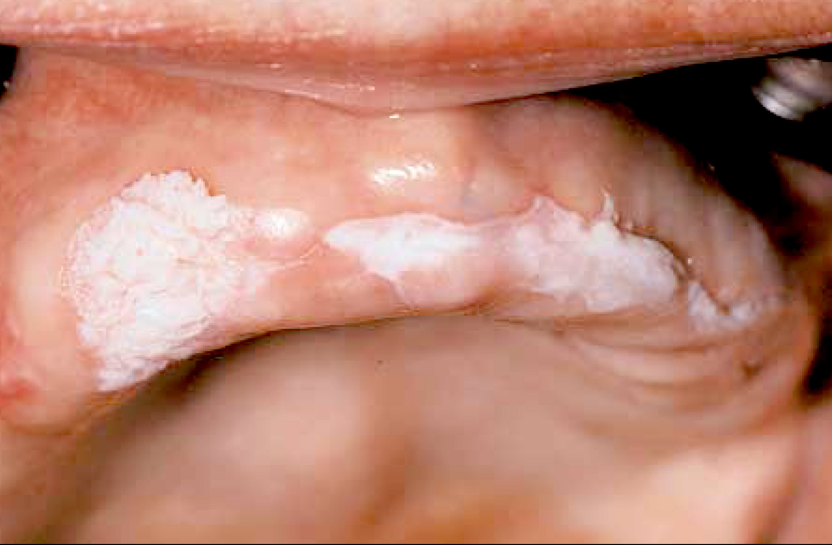 Squamous Cell Carcinoma
