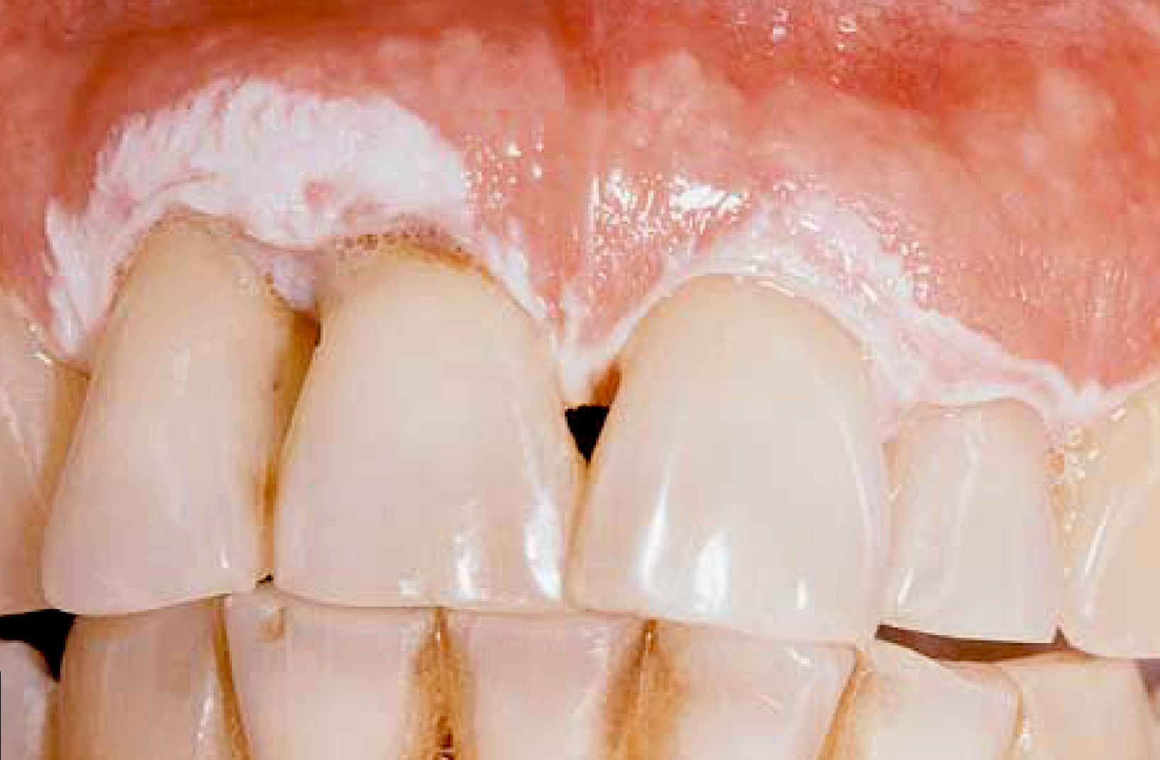 Verrucous Leukoplakia