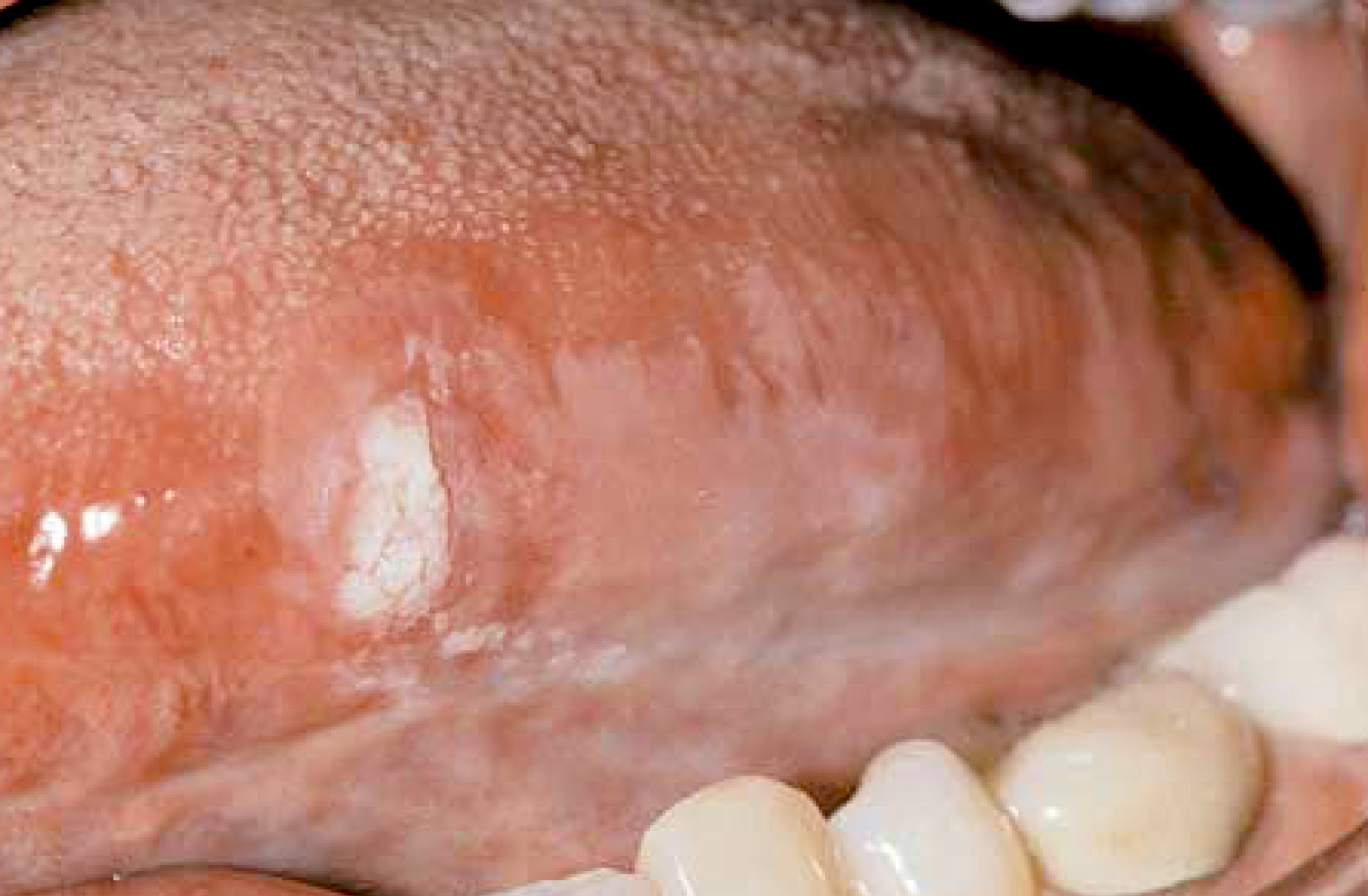 Early squamous cell carnicoma