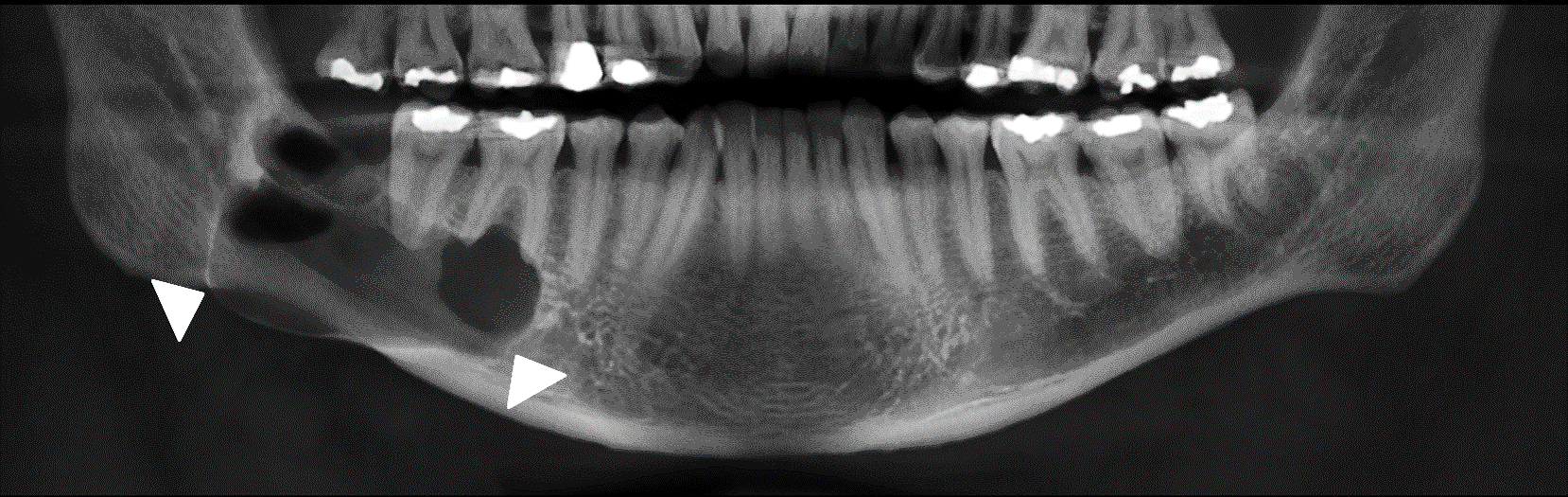 Ameloblastoma Dento Metric Radiología Dental, Oral y Maxilofacial