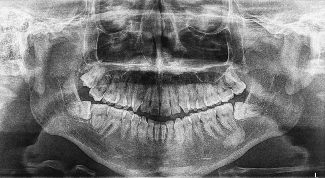 Osteoma Periférico en Mandíbula Dento Metric Radiología Dental