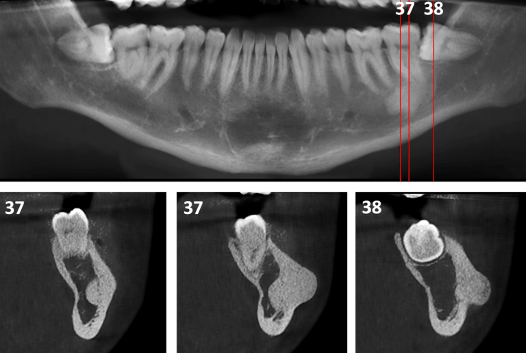 Osteoma Periférico en Mandíbula Dento Metric Radiología Dental