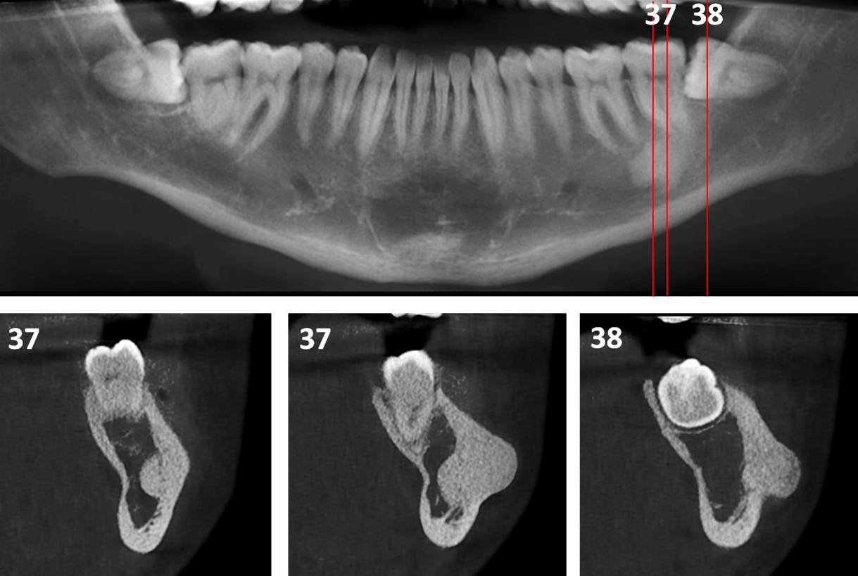 Osteoma Periférico en Mandíbula Dento Metric Radiología Dental