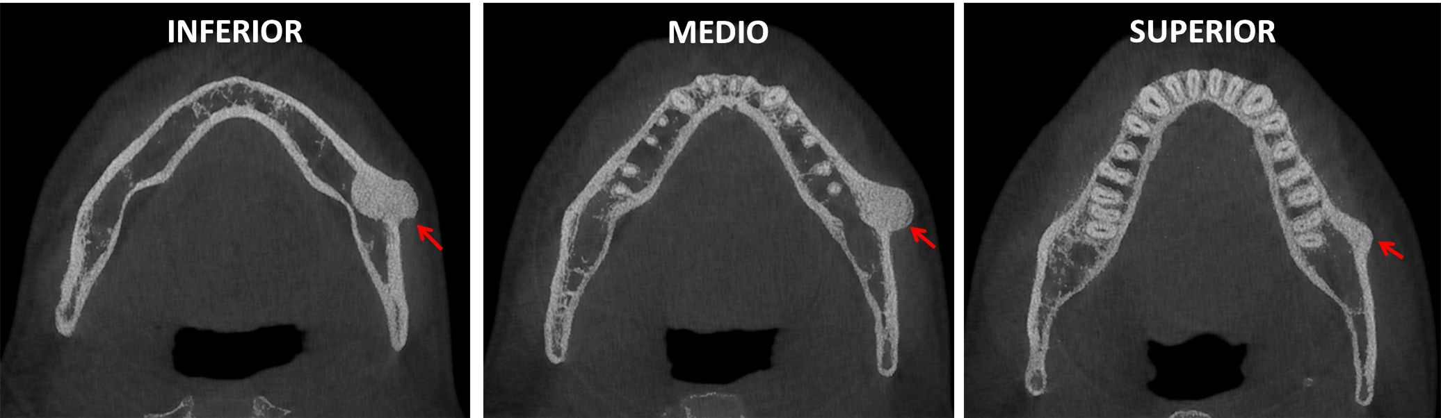 Osteoma Periférico en Mandíbula Dento Metric Radiología Dental