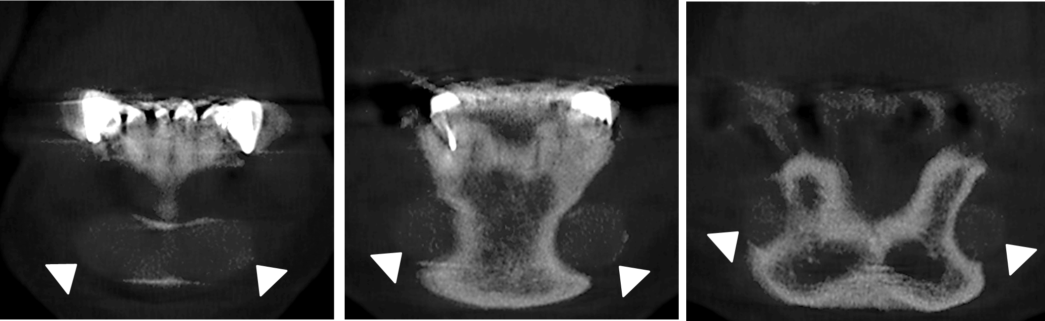 Implante de Mentón Dento Metric Radiología Dental, Oral y Maxilofacial