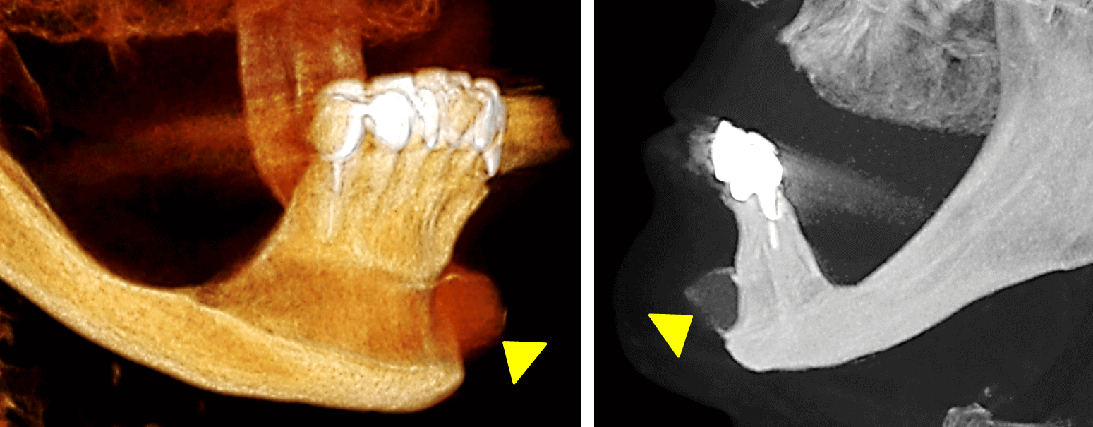 Implante de Mentón Dento Metric Radiología Dental, Oral y Maxilofacial