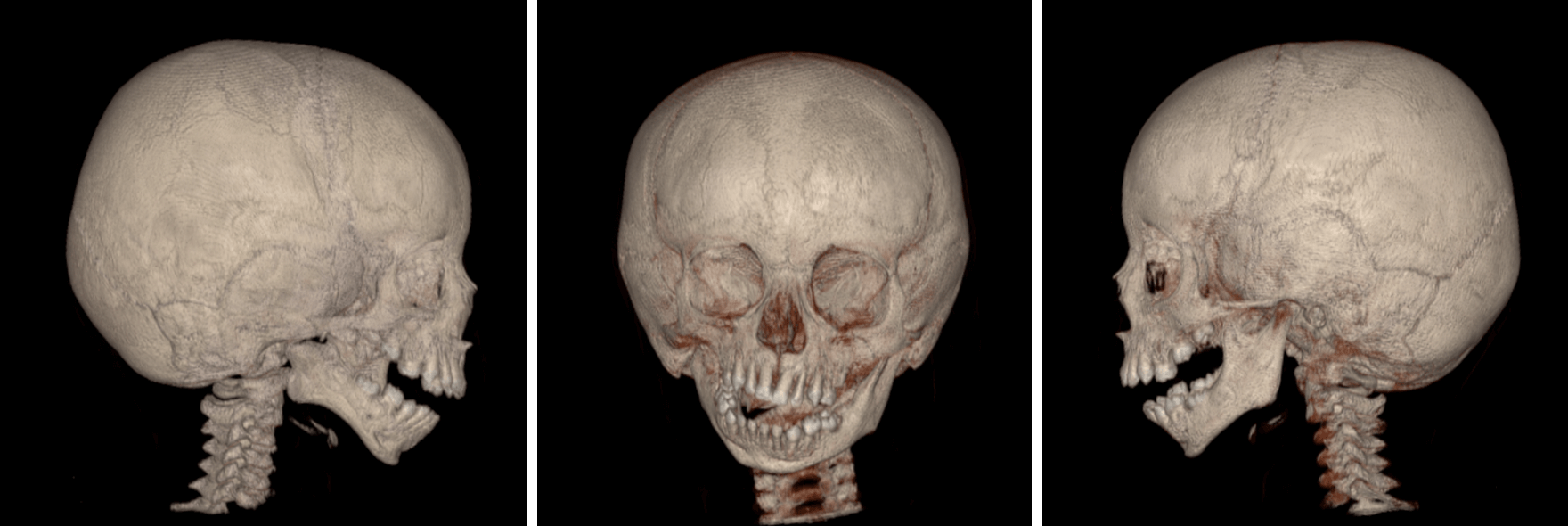 Síndrome de Goldenhar Dento Metric Radiología Dental, Oral y