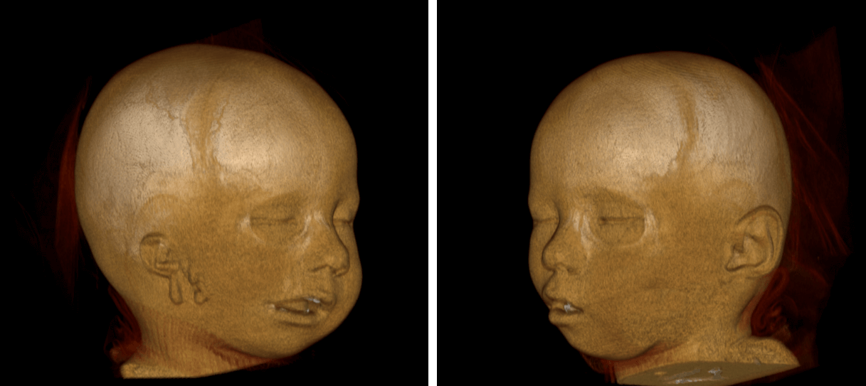 Síndrome de Goldenhar Dento Metric Radiología Dental, Oral y