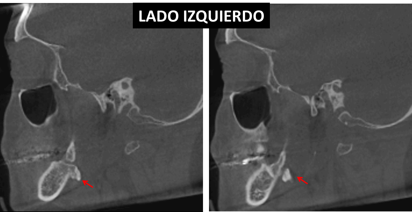 Osteoma pediculado en rama ascendente Dento Metric Radiología