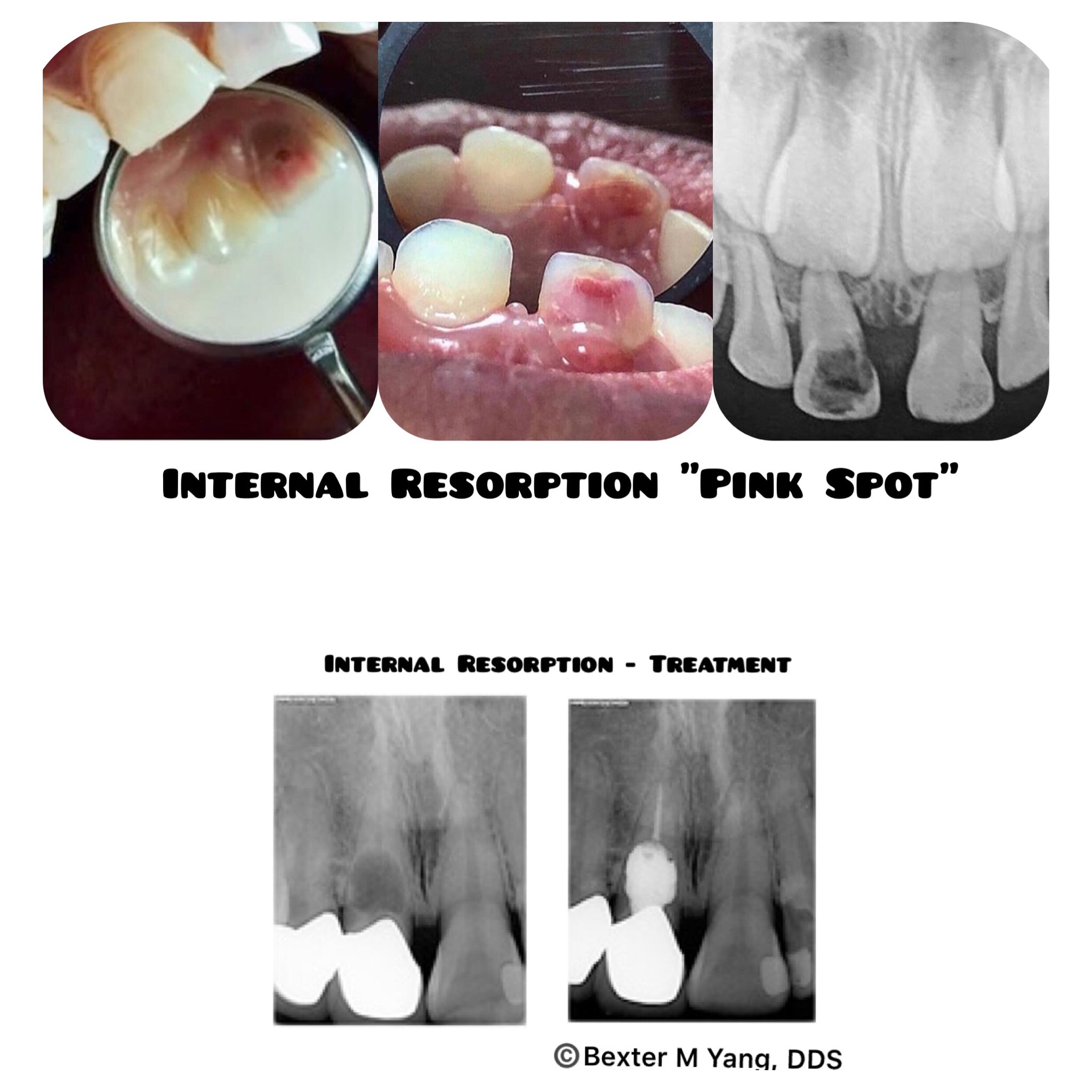 Internal Vs. External Resorption Dentowesome