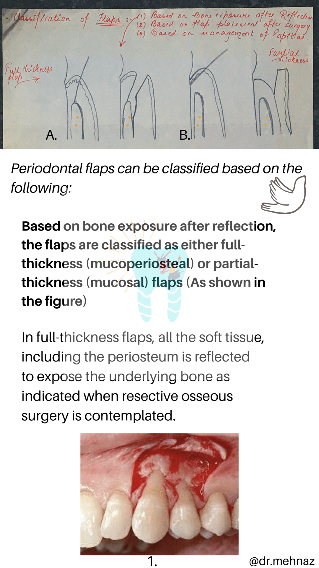 THE PERIODONTAL FLAP Dentowesome