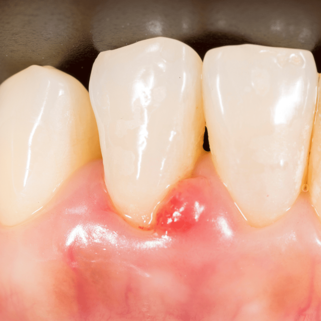 Periodontal / Gum Disease Dentraveller