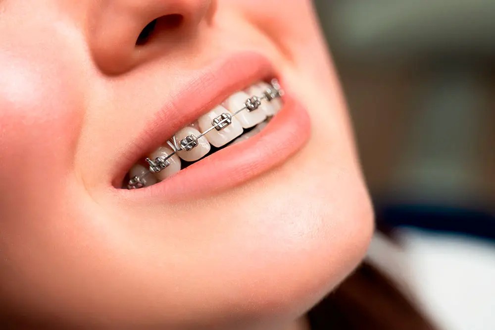 Brackets Dentric