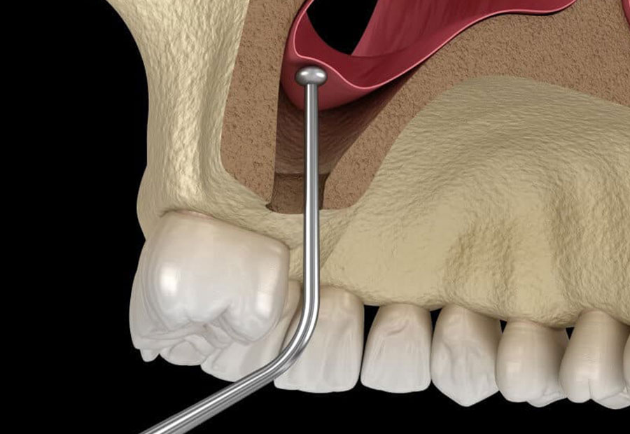 DenTroya SINUS LIFTING