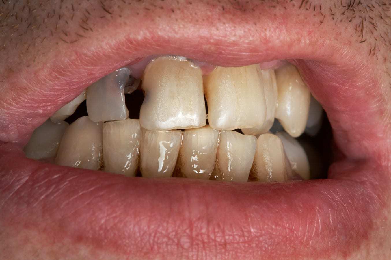 Próchnica zębów Dentysta.eu Marcin Krufczyk