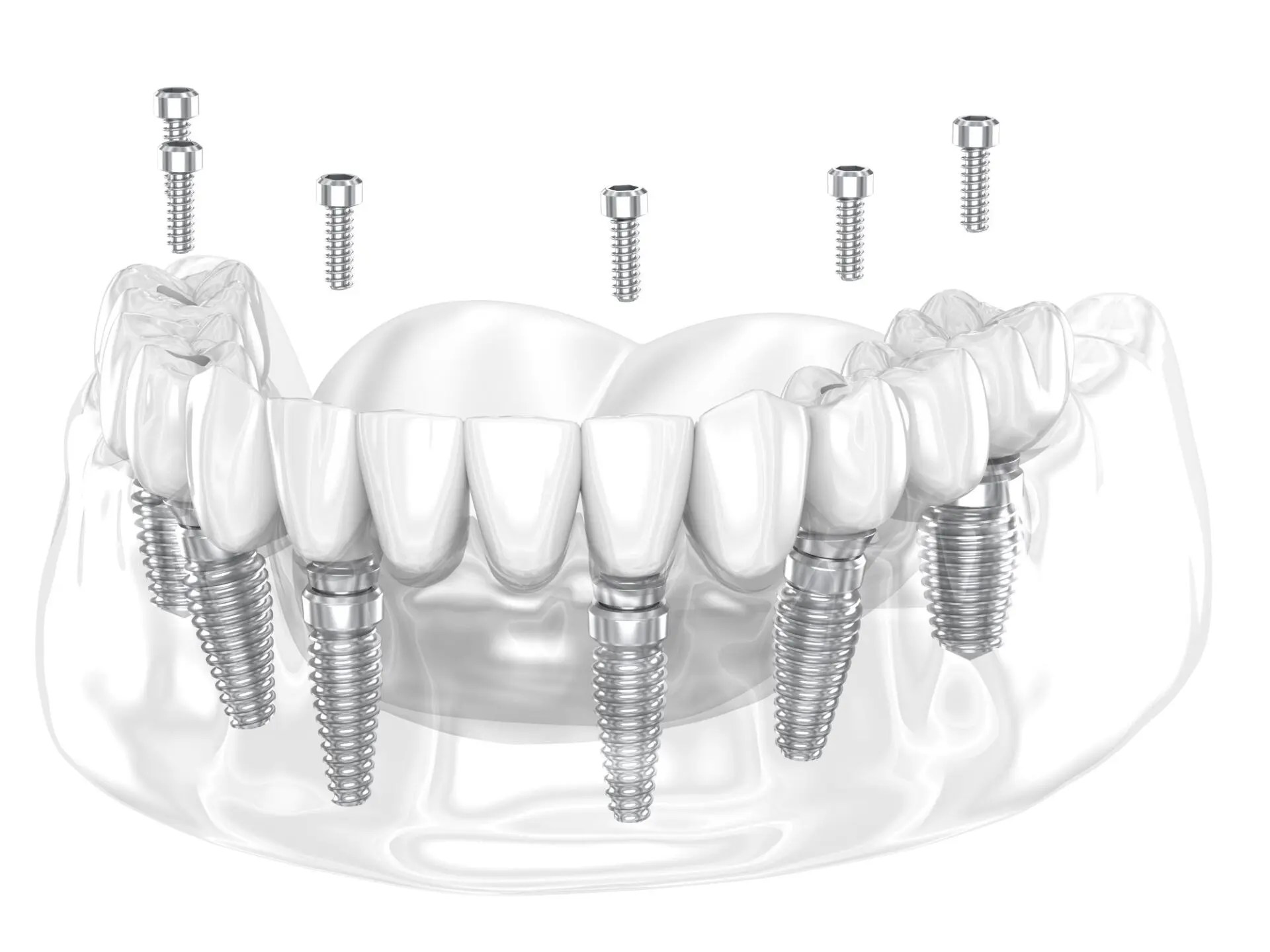 Partial Dentures in Denver