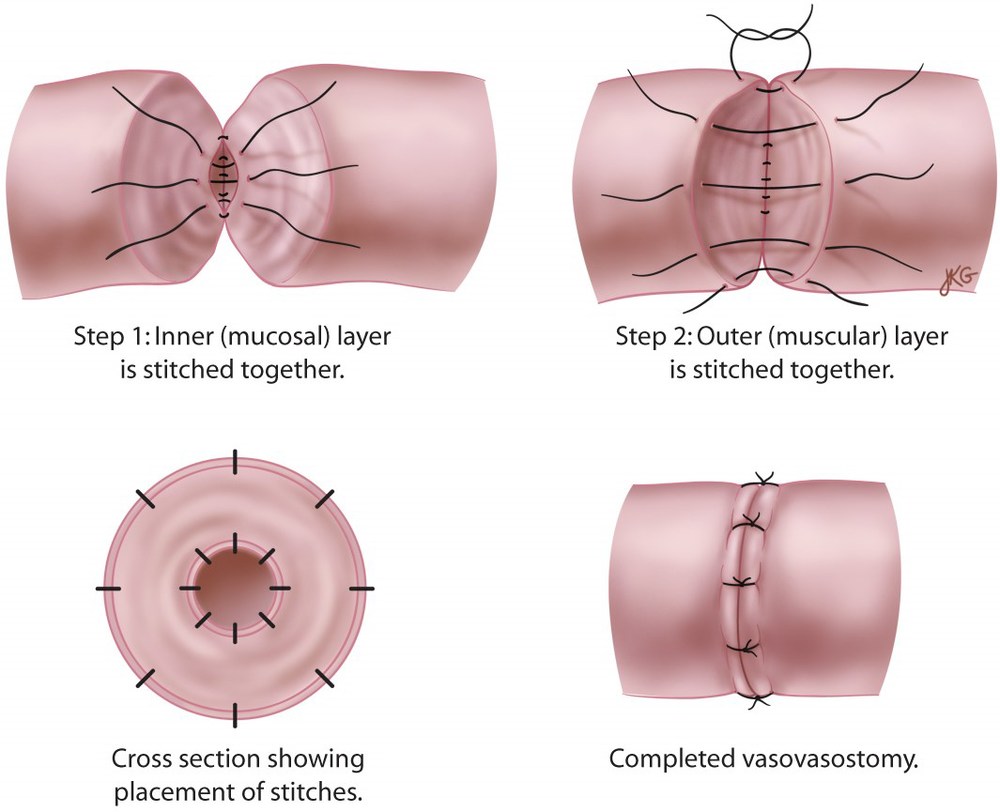 How Much Does A Vasectomy Reversal Cost With Insurance