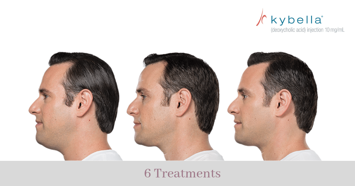 Kybella® "Double Chin" Treatments in Gainesville FL