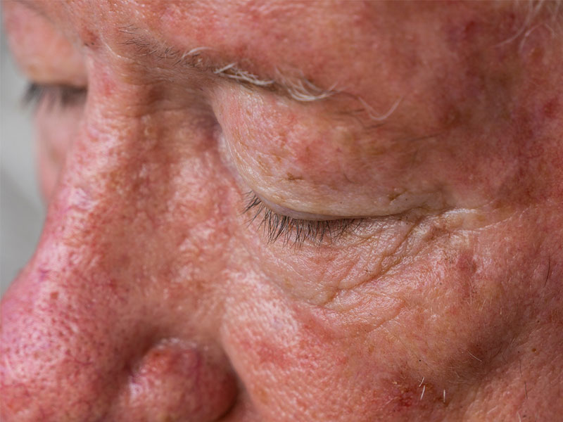 How Do You Remove Sun Spots On Your Face?