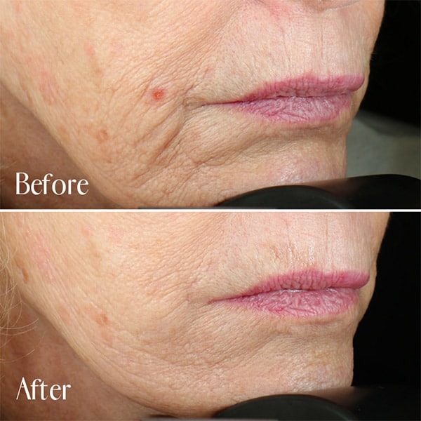 Vivace® Microneedling Laser Hair Removal & Laser Tattoo Removal