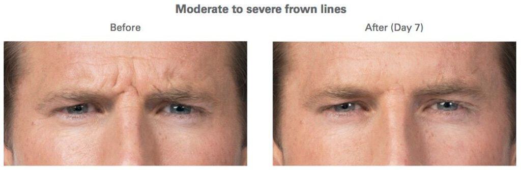 BOTOX Hampton Roads, VA Beach, Norfolk Laser Hair Removal & Laser
