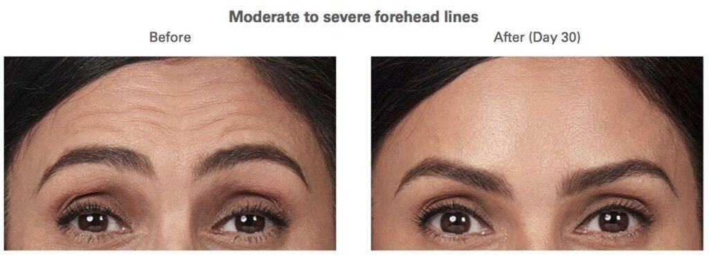 BOTOX Hampton Roads, VA Beach, Norfolk Laser Hair Removal & Laser