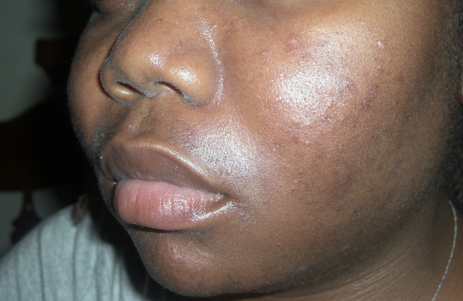 Acne Problems Dermadee Skin Care Centre, Gaborone, Botswana