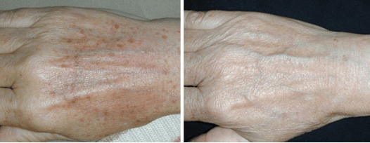 IPL Versatile, Cost effective, and Results driven DermaJEM