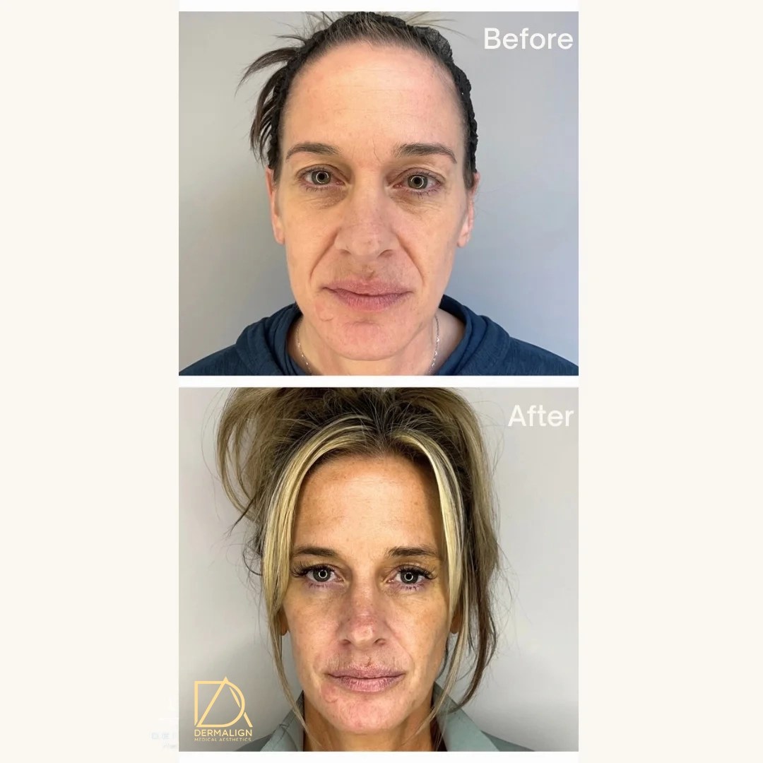 Best Before & After Results 50+ Facial Photos(04)