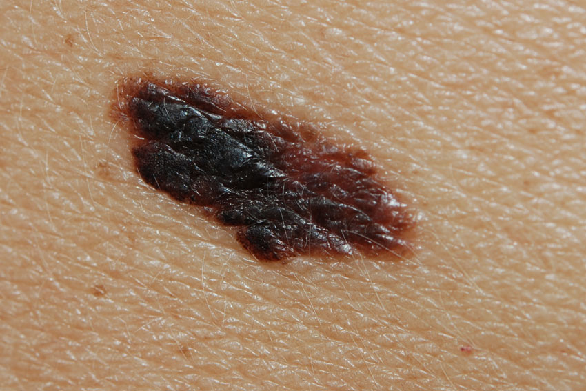 Melanoma of the skin pictures and clinical information