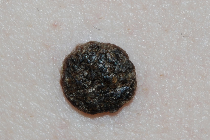 Senile warts pictures and clinical information