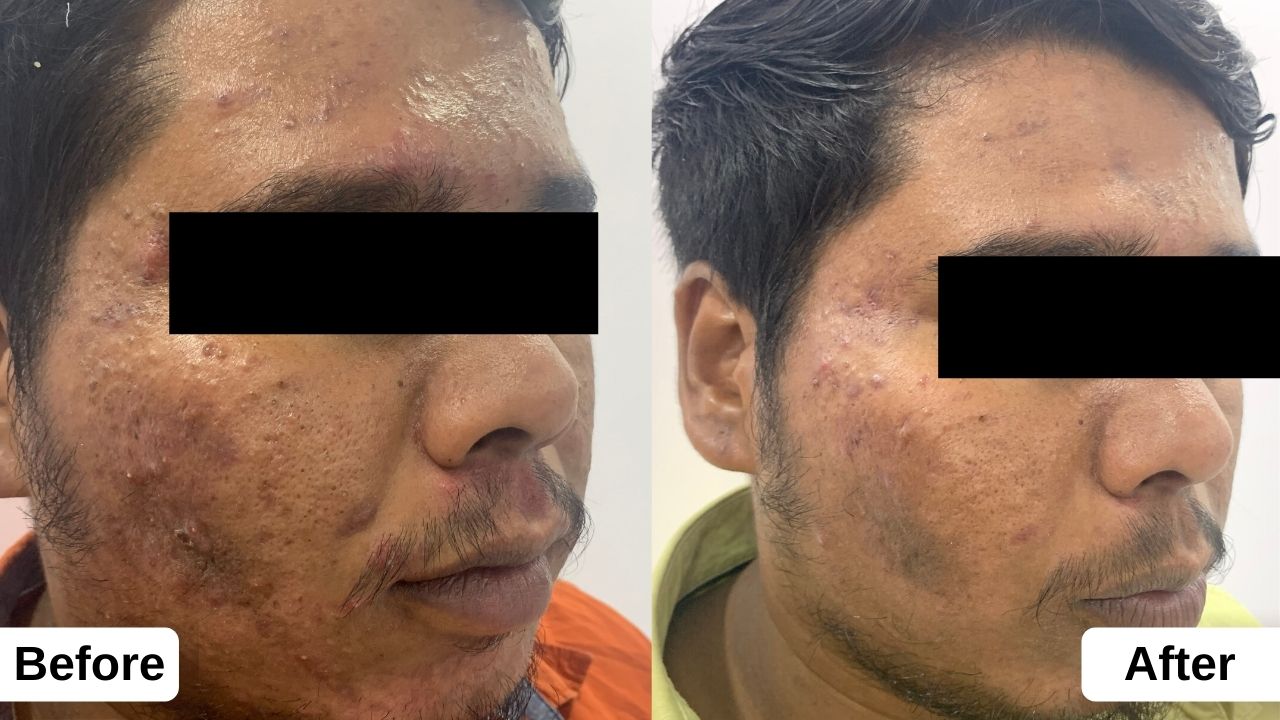 Solution for Acne Treatment & Cost Derma Space