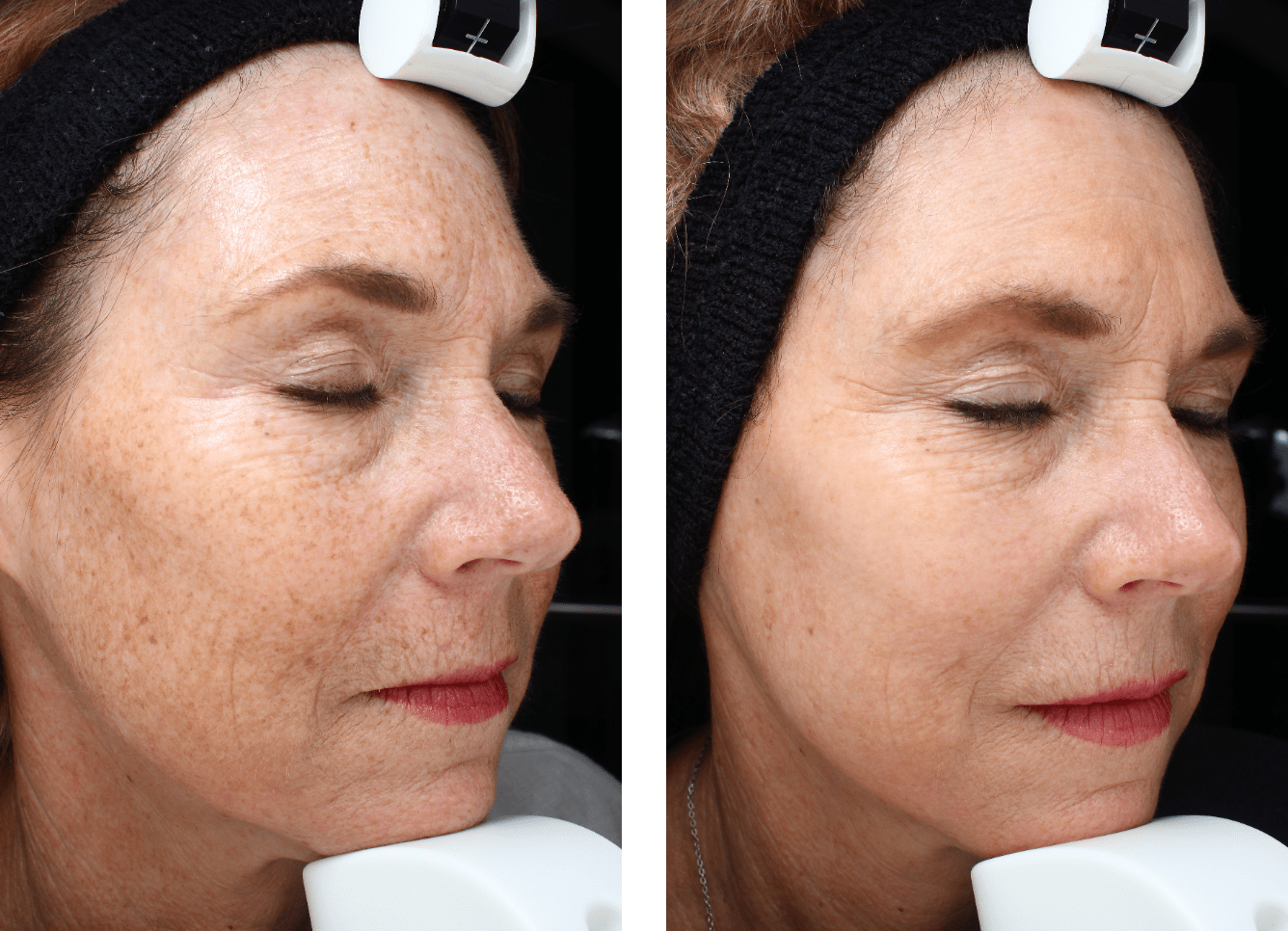 IPL Skin Rejuvenation Sacramento, CA Emil A. Tanghetti, MD