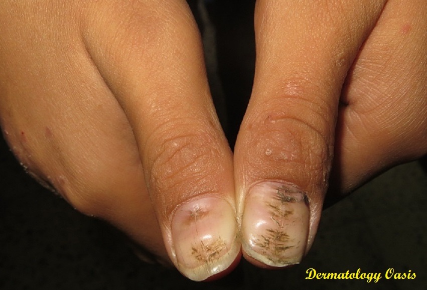 Fungal Infections Fungal CDC Centers for Disease.