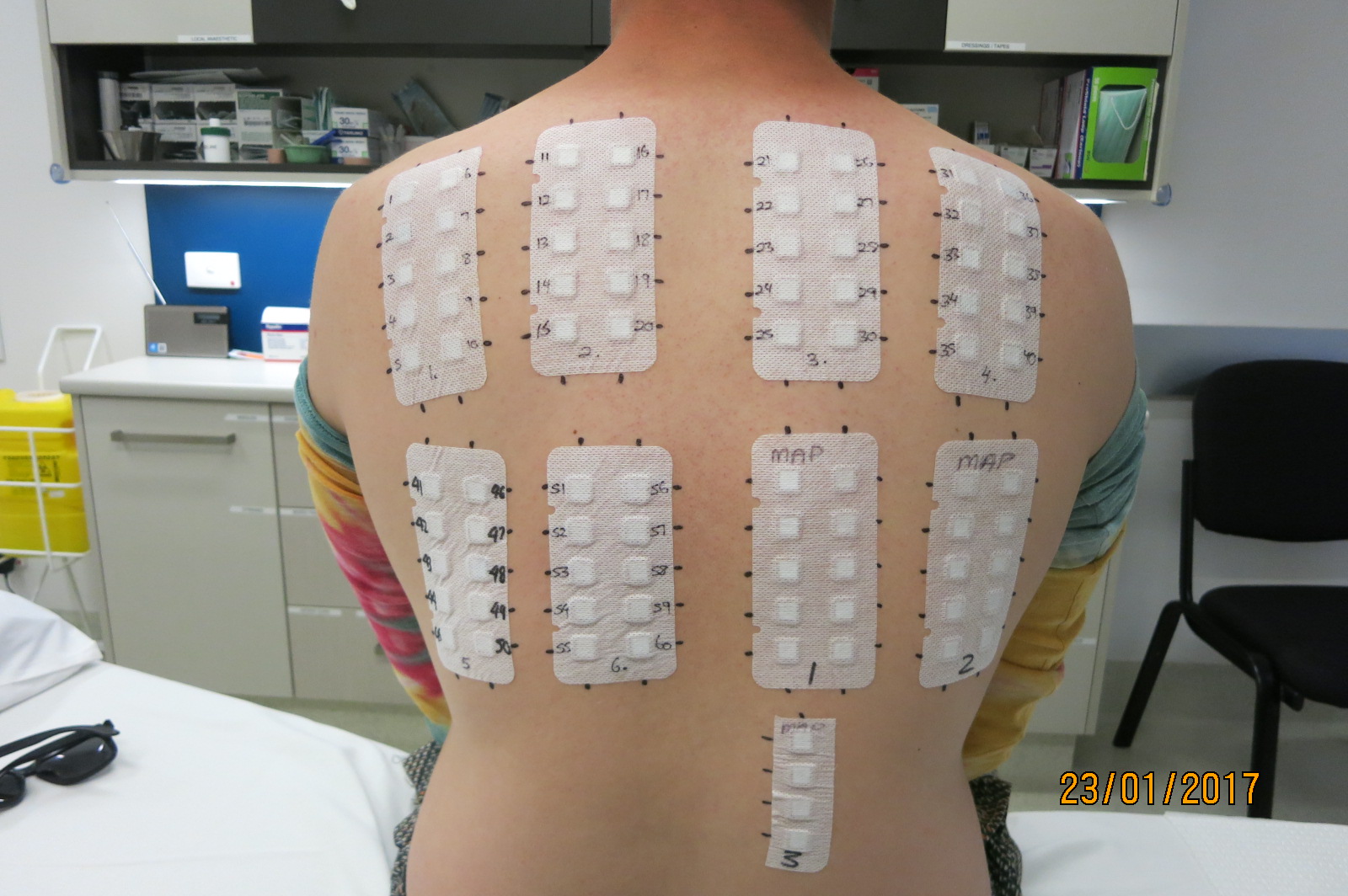 Dermatology SA Patch Testing » Dermatology SA