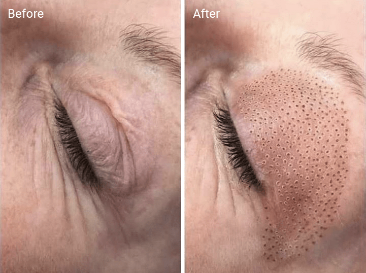 plasma skin tightening