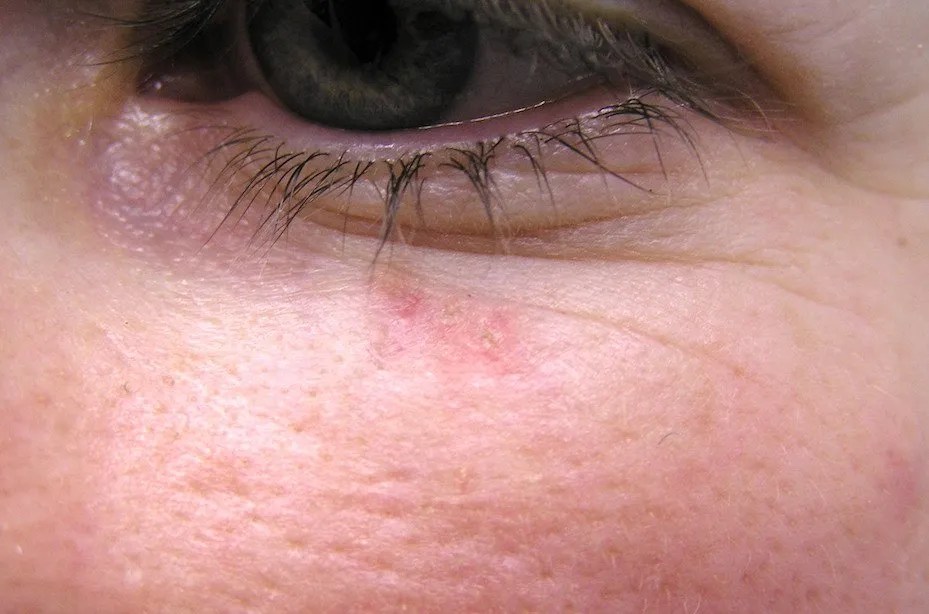 Adjusting for Risk Skin Cancer DermLetter