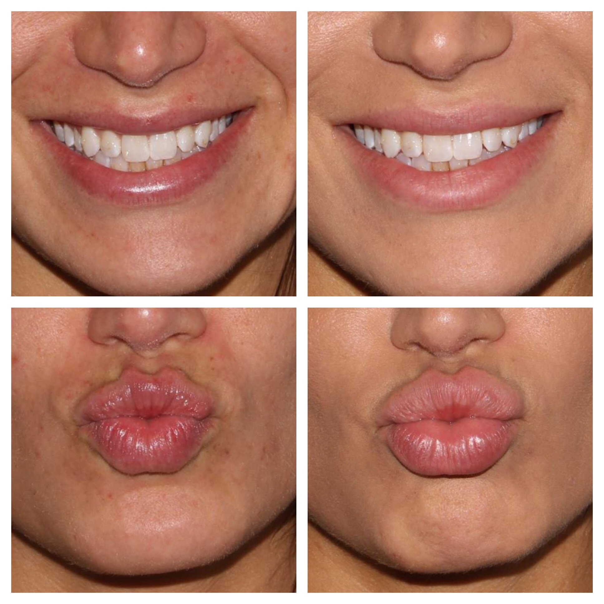 Restylane Dermatologist Near Me