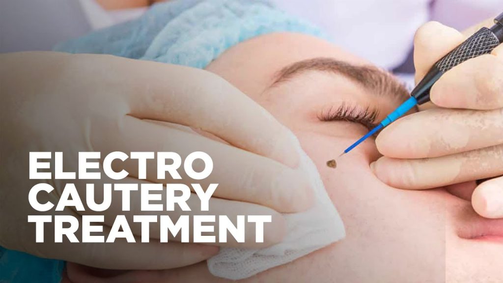 Electrocautery After Care DermNurse Medical Aesthetics