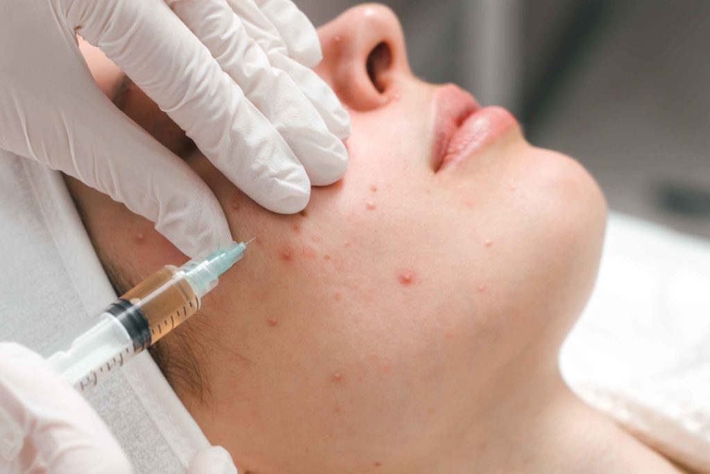 ACNE Cyst Kenalog Injection Aftercare Tips for Recovery