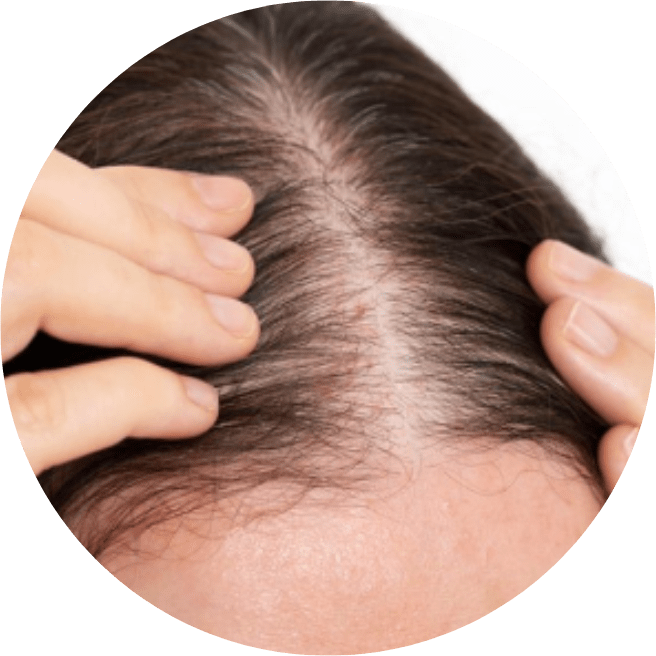Hair Loss Treatment DermOnDemand