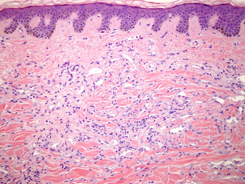 Atypical Vascular Lesion 2 Dermatopathology